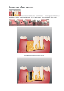 Имплантация зубов в картинках
