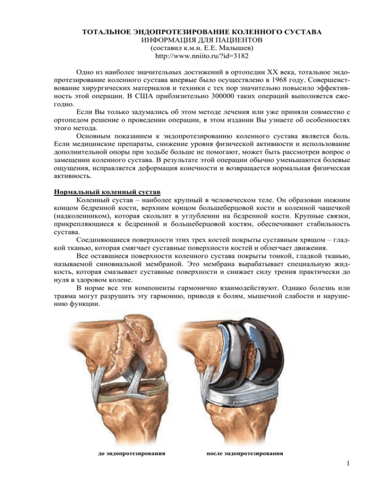 Отзывы после операции на суставе. Протокол операции эндопротезирования коленного сустава. Предоперационное планирование эндопротезирования коленного сустава. ТЭП эндопротезирование коленного сустава. Эндопротезирование коленного сустава схема.