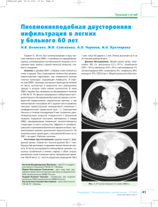 Пневмониеподобная двусторонняя инфильтрация в легких у