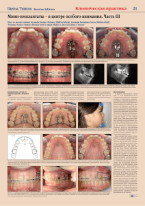 Мини-имплантаты - Dental Tribune International