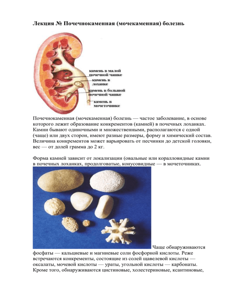 Классификация мочекаменной болезни