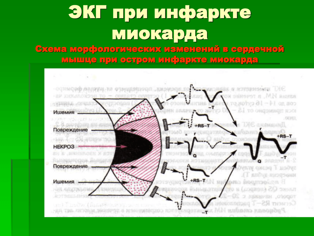 Экг 22. Схема инфаркта миокарда на ЭКГ. Острый инфаркт миокарда кардиограмма. Изменения на ЭКГ остром инфаркте миокарда. Изменения на кардиограмме при инфаркте миокарда.
