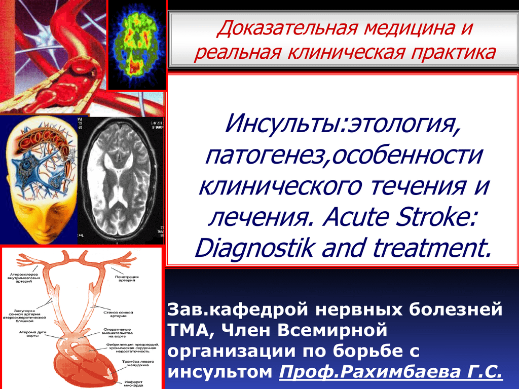 Инсульт правого бассейна. Кардиоэмболический инсульт. Кардиоэмболический инсульт патогенез. Этиология ишемического инсульта. Инсульт в бассейне средней мозговой артерии.