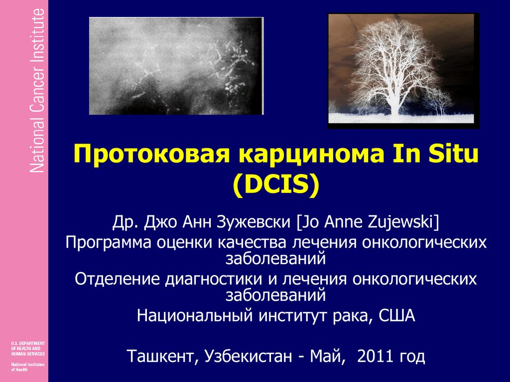 Протоковая карцинома in situ молочной