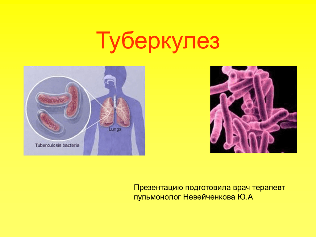 Презентация про туберкулез. Туберкулез презентация. Туберкулёз презинтация. Туберкулез презентация фтизиатрия. Туберкулёз призентация.