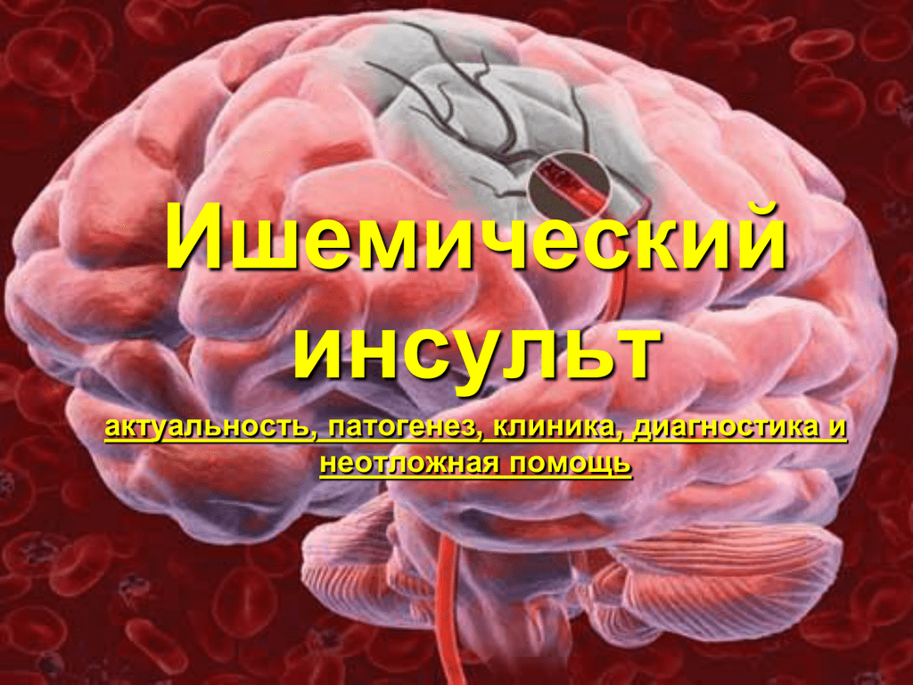 От инсульта умирают. Инсульт. Актуальность инсульта. Актуальность ишемического инсульта.