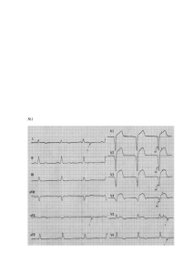 ЭКГ при инфаркте миокарда
