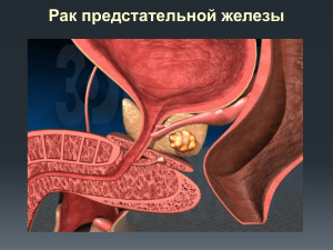 Рак предстательной железы