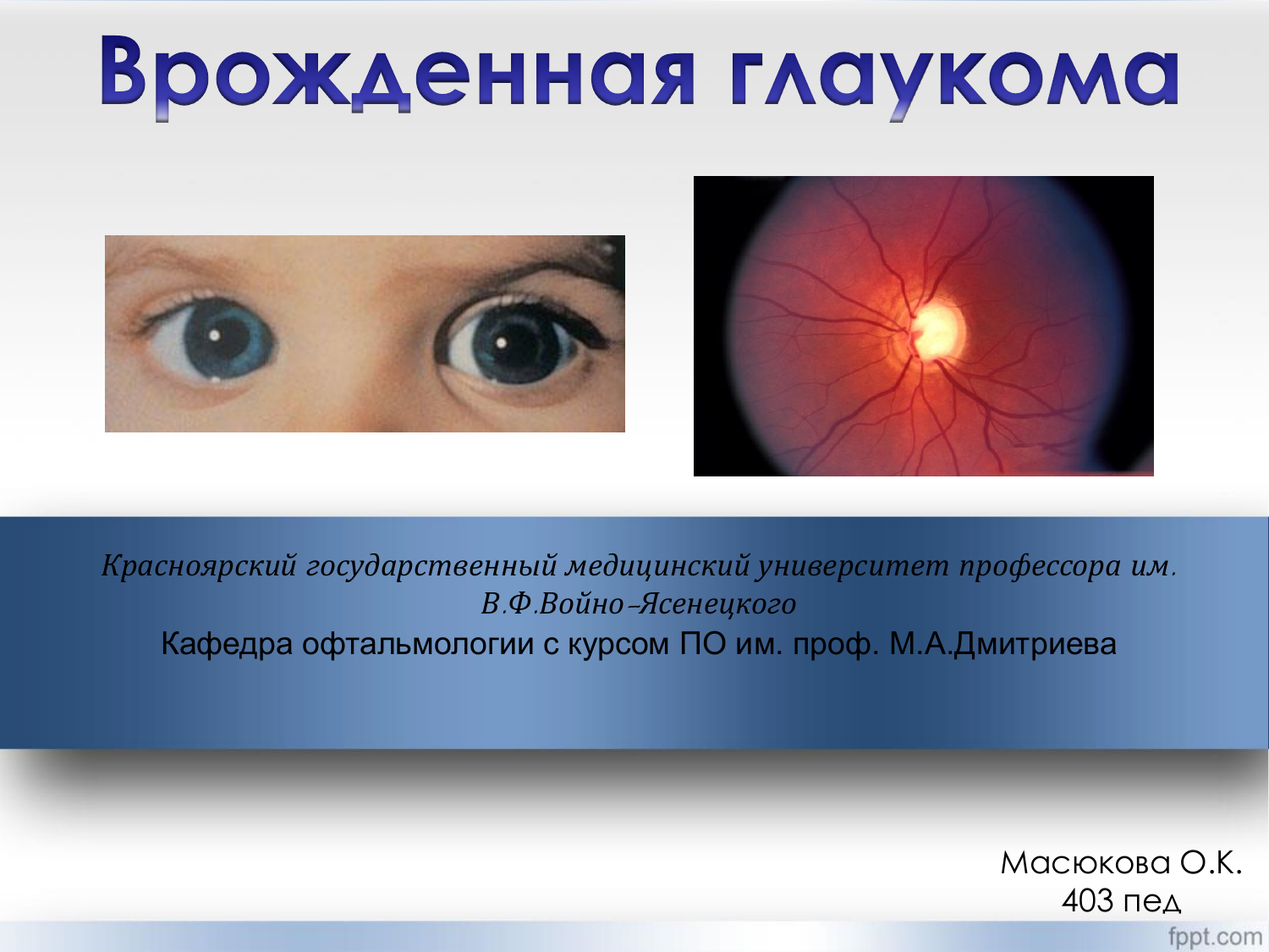 Один из супругов страдает глаукомой. Ювенильная врожденная глаукома. Врожденная инфантильная ювенильная глаукома. Врожденная глаукома глаза. Врожденная глаукома симптомы.